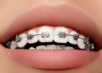 有牙套的美丽的白牙 牙科护理照片 女人微笑与矫形配饰品 整形治疗女性矫正牙齿宏观美白诊所金属保健陶瓷女孩图片