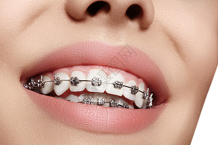有牙套的美丽的白牙 牙科护理照片 女人微笑与矫形配饰品 整形治疗女性女士美白牙医牙齿矫正医生口腔科制品成人图片