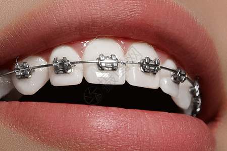 有牙套的美丽的白牙 牙科护理照片 女人微笑与矫形配饰品 整形治疗制品皮肤医生口腔科牙齿卫生金属女性快乐矫正图片