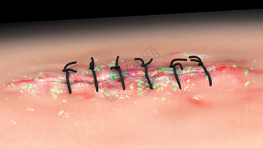 当细菌进入皮肤破裂时 会发生伤口感染而药品外科援助疾病钳子伤害愈合帮助医生纱布图片