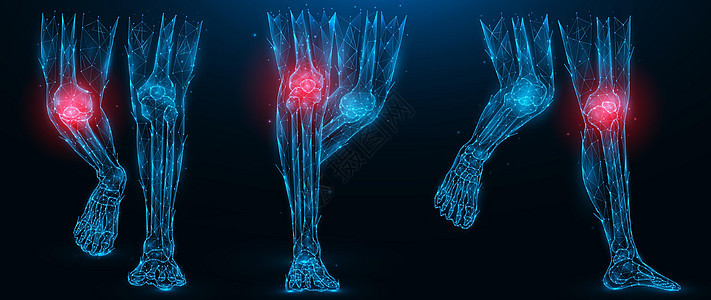 人类腿部的多角矢量说明 膝关节概念的发炎性疾病 深蓝色背景下肢低聚能艺术图片