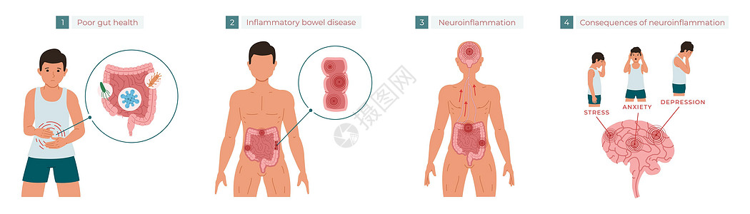 肠道健康不佳会导致慢性炎症 进而导致神经炎症 从而导致压力 焦虑和抑郁 矢量图图片