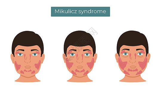 Mikulicz综合症的矢量说明 扩大粪便和口腔腺图片