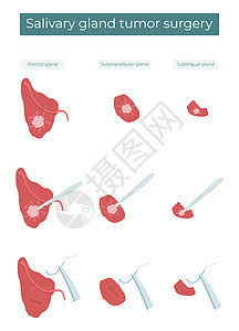 以矢量平方表示手术将肿瘤从 亚脑和亚语言的血清腺中除去图片