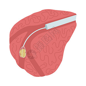 腰椎管狭窄症内皮外科手术的矢量插图 以将一块石头从唾液腺中除去插画