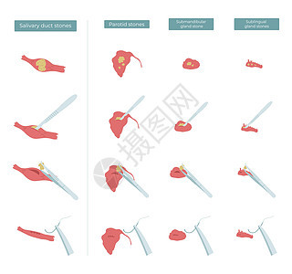 用矢量平方说明手术 将石块从鹦鹉状 亚管状和亚语言的血清腺中除去图片