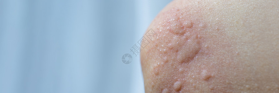 皮肤上的荨麻疹 儿童皮肤过敏反应的红点 荨麻疹症状特写药品身体症状湿疹医生红色感染疾病痛苦水泡图片