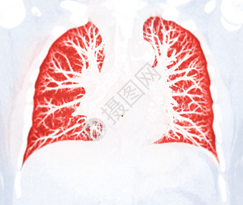 CT 为检测出肺结核预设的胸肺辐射诊断电影扫描癌症屏幕肋骨电脑心脏病学药品图片