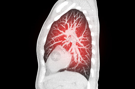 对肺部感染的胸腔或肺表层微米进行CT扫描 与地面玻璃不透明共诊19次图片