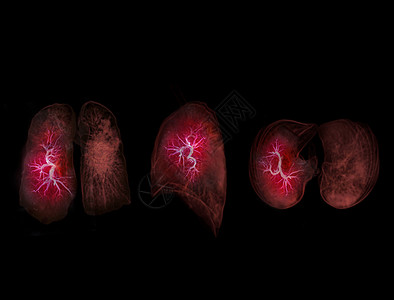 CT切斯特或肺3D的选择性重点 为诊断肺病 肺结核或结核病和食欲19提供图像图片