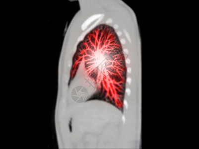 CT 诊断性肺癌 肺结核和大肠杆菌19的剖腹产MIP观察注射肺部科学渲染胸部检查血管射线心血管3d图片