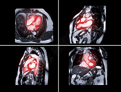 收集 MRI 心脏或心脏的心脏 MRI 磁共振成像用于诊断心脏病图片