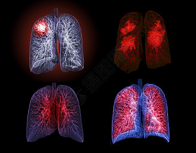 CT切斯特或肺3D选择性地聚焦于TB 肺结核和共生19的诊断监视器渲染隔膜器官癌症疾病肺炎药品心脏病学医院辐射图片