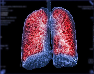 CT切斯特或肺3D选择性地聚焦于TB 肺结核和共生19的诊断监视器放射科器官解剖学屏幕心脏病学疾病药品3d结核哮喘图片