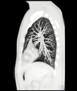 CT 诊断性肺癌 肺结核和大肠杆菌19的剖腹产MIP观察血管断层主动脉注射解剖学肺部检查扫描心血管胸部图片