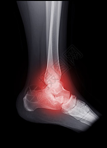 脚踝关节X光图像 用于诊断骨折和纤维骨伤害胫骨电影医生病人碰撞膝盖踝关节外科金属图片