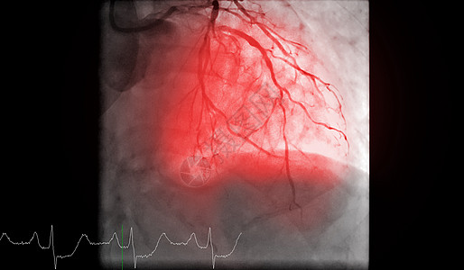 心脏导管化是一种测试 用来检测心跳停止医院导管心脏病学树干诊断动脉干涉心血管情况核磁共振图片