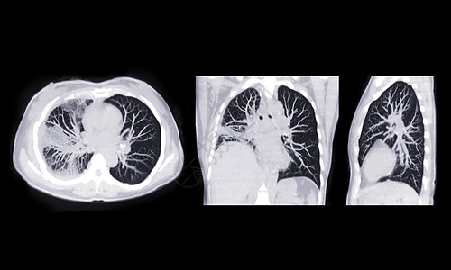CT扫描胸腔或肺轴 日冕和肩部的肺部感染 与地面玻璃不透明共存19度背景图片