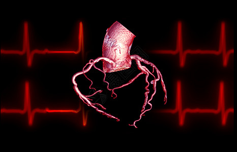 CTA 冠动脉3D在屏幕上显示图像 以诊断船只冠动脉衰竭病人胸痛心脏病动脉心脏病学医生心律失常放射科考试疾病图片