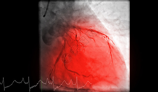心脏导管化是一种测试 用来检测心跳停止心导管术胸部成人疼痛树干核磁共振疾病血管心脏病学攻击图片