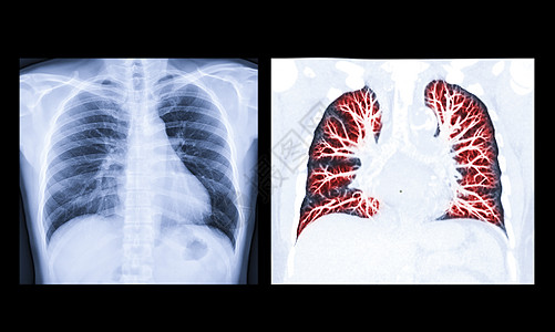 显示肺结核的人类胸前或肺部横向视图红区切片X光或X光图像胸椎电脑结核辐射科学病人器官心脏病学肋骨诊断图片