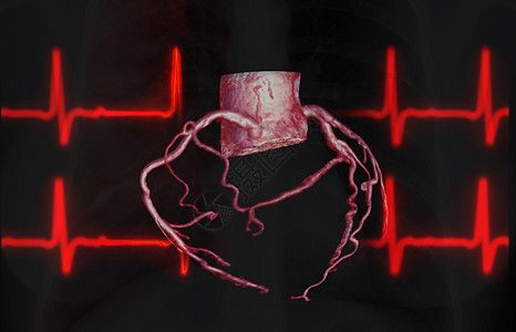 CTA 冠动脉3D在屏幕上显示图像 以诊断船只冠动脉衰竭断层病人考试放射科动脉瘤心脏病学检查心血管主动脉器官图片