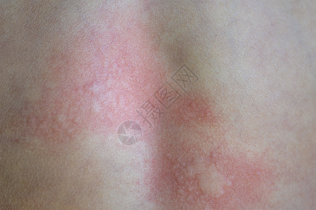 皮肤上的荨麻疹 儿童皮肤过敏反应的红点 荨麻疹症状特写湿疹水泡孩子过敏红斑皮肤科痛苦症状医生治疗图片