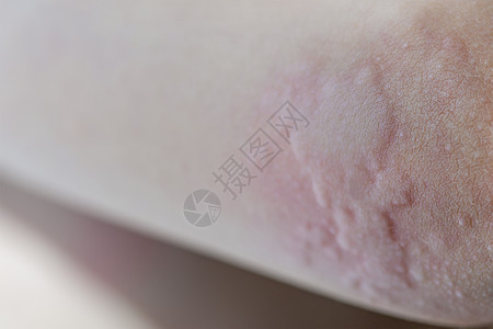 皮肤上的荨麻疹 儿童皮肤过敏反应的红点 荨麻疹症状特写表皮症状感染皮疹斑点身体水泡痛苦红斑病人图片