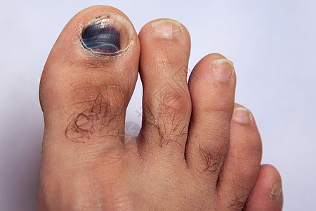 右脚脚指甲的伤痕图片