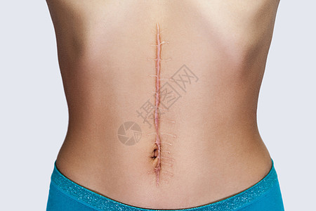 在腹部外科手术后 有大伤疤的年轻女性被关上图片