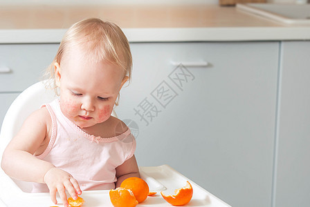 长着食物过敏的可爱小孩幼儿卫生保健症状湿疹孩子婴儿疼痛皮肤女孩白色图片