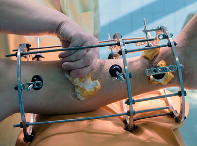 整形医学外部环固定术技术外戒指事故手术仪器绷带病人外科投掷创伤保险图片