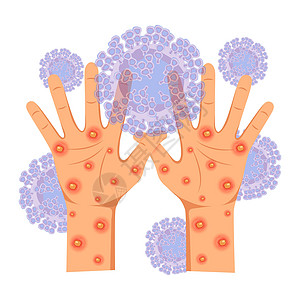 受皮疹 净化溃疡影响的人的手图片