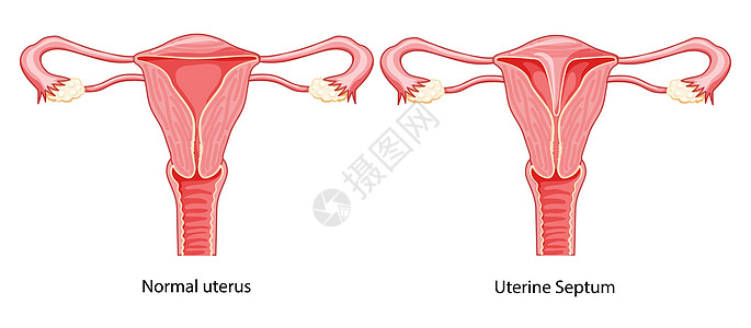 一组子子宫间隔膜 以正常和有病的子宫为主 女性生殖系统图图片