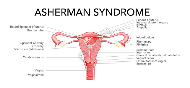 子宫图中的女性生殖系统疤痕组织粘合 上面有刻有字的表象 前视生育力妇科腹部怀孕癌症骨盆卵巢生殖器身体妇科医生图片