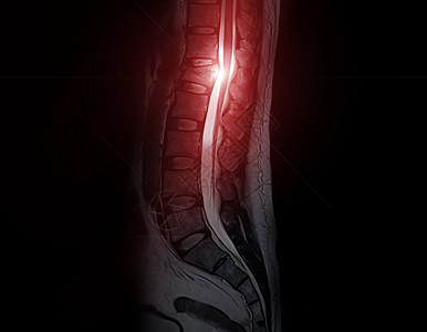 MRI Lumbar脊椎长尾T2W脂肪抑制背痛疼痛诊断椎间外科疾病扫描器椎骨身体腰背图片