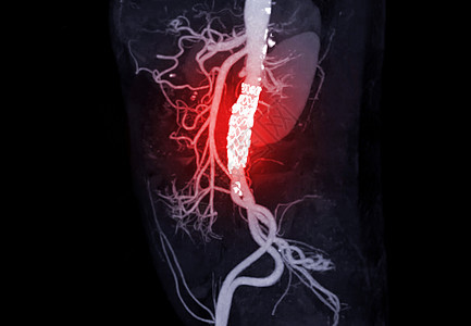 腹部动脉的CTA病人手术3d凝块血管科学外科疾病心血管器官图片
