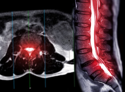 MRI LS 脊椎或腰脊轴轴T2W视图 带有人造平面骨科疼痛谐振医学扫描解剖学背痛技术诊断神经图片