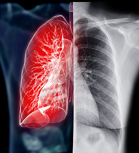 胸腔X射线和肺3D投影图片