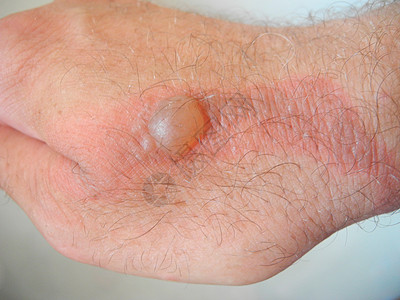 灰色背景的男性手上可怕的灼伤瘢痕药品帮助皮肤医疗白色创伤感染疼痛伤口图片