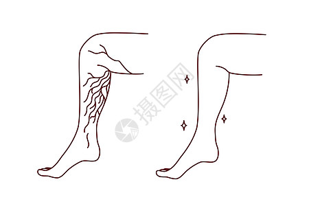 静脉变动的病人腿卡通片血栓疼痛浮肿曲张成人插图动脉身体保健背景图片