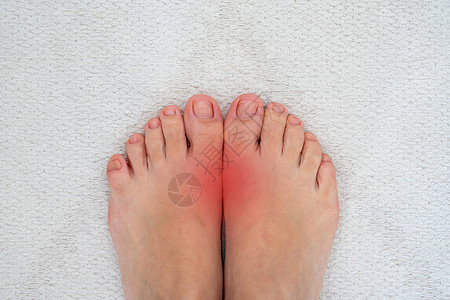 风湿病和痛风病 大脚趾与红点接头的疼痛性口味炎症疾病痛苦手指药品病人医疗骨科女士女性痛风图片