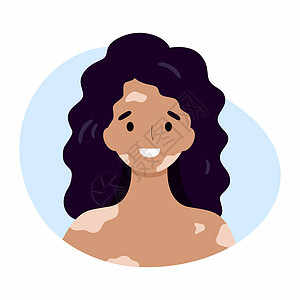 一个幸福的白癜风女人 这个女孩患有面部和身体皮肤问题颜料快乐疾病烧伤痛苦老年斑细菌过敏头发皮肤科图片