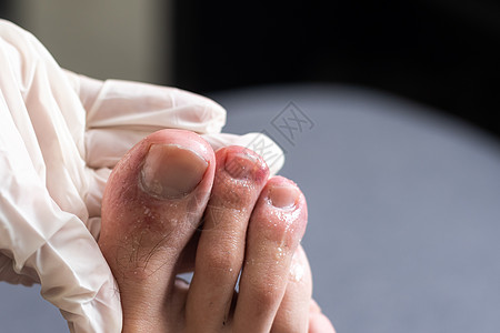 男人的脚趾显示什么看起来像红发皮肤皮疹 Covid19通常被称为Covid脚趾的一个常见副作用治疗痛苦疾病冻疮病变皮肤科水泡荨麻图片