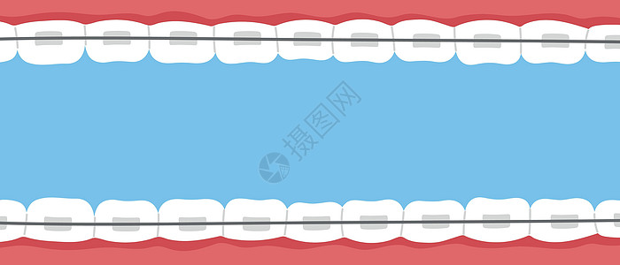 牙牙套横幅 正统问题 带括号的微笑 预留符 Flat 矢量孤立插图牙齿矫正陶瓷网站支撑卡通片海报打扫绘画牙医图片