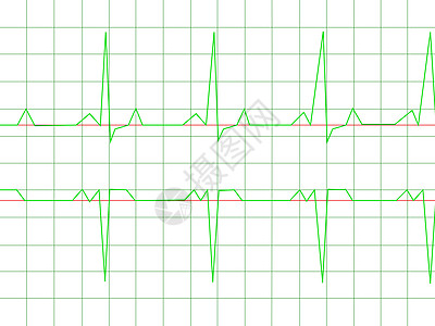 正常心心节奏电气压力病人技术信号海浪情况速度医院生活图片