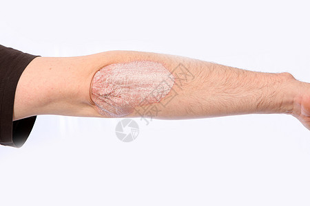 微丝虫病药物皮肤湿疹疾病人体皮疹皮炎痛苦烧伤医生图片