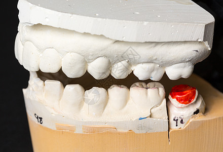 用于整牙术的假牙科学塑料铸件假肢微笑牌匾矫正正畸学衰变药品图片