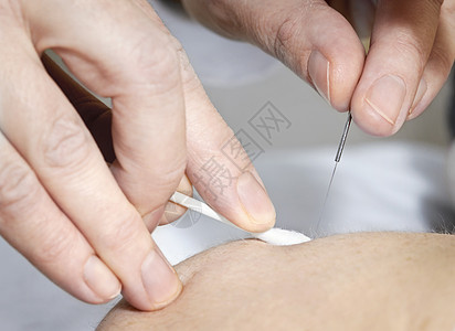 皮肤针刺针头手指治疗保健药品穴位男性福利卫生拭子棉布图片