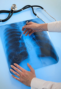 肺部X光照片诊断胸部手术外科辐射医师医院卫生考试诊所图片